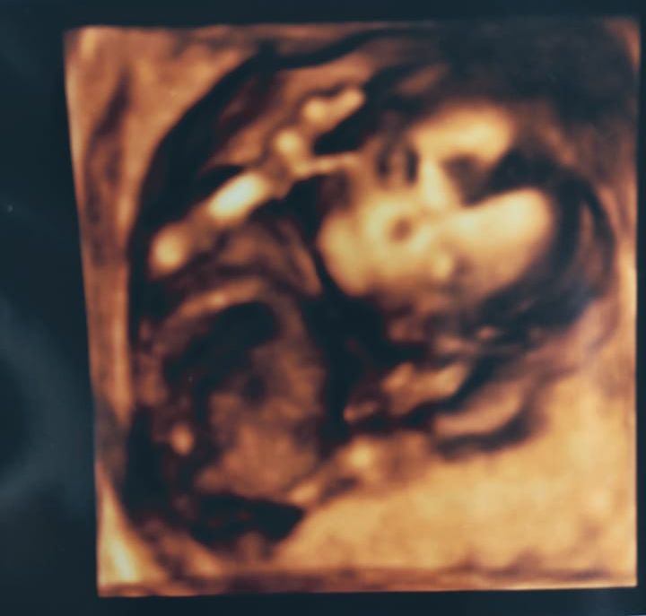 17w4Ｄエコー写真